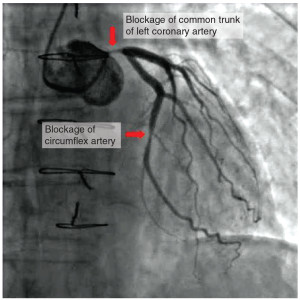 Abnormal coronary angiogram. This picture shows disease in 2 arteries of the heart.