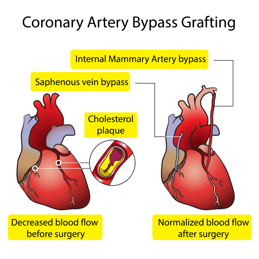 Coronary Artery Bypass Grafting (CABG) Simplified Heart Sense