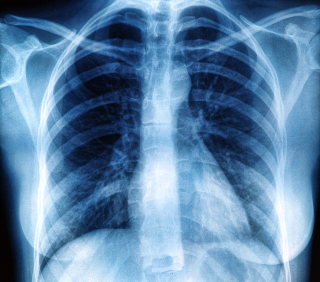 Chest X-Ray - Heart Sense