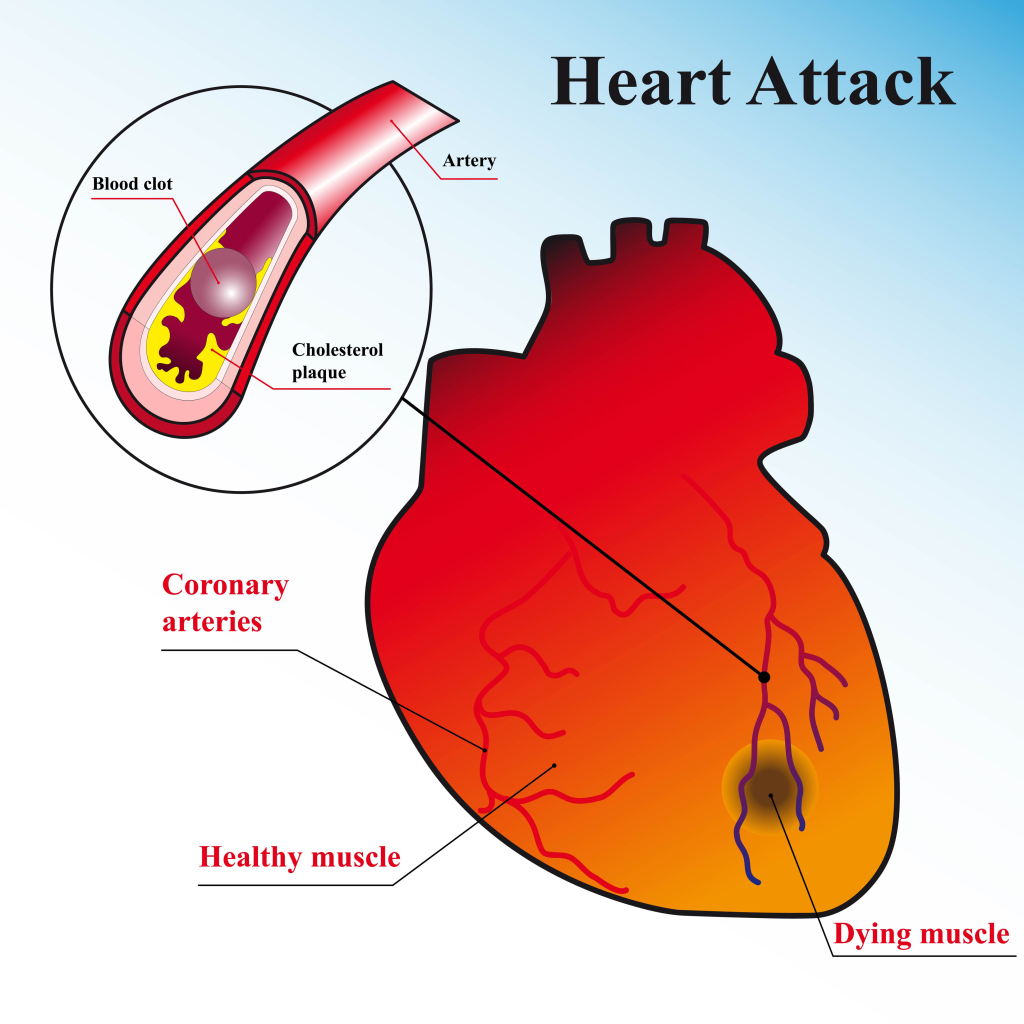 Can Heart Attack Cause Low Hemoglobin