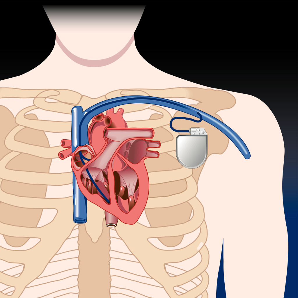 pacemaker-battery-replacement-signs-of-low-battery