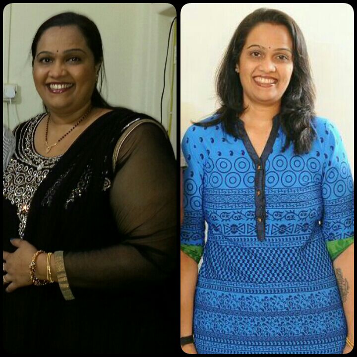 weight loss surgery success