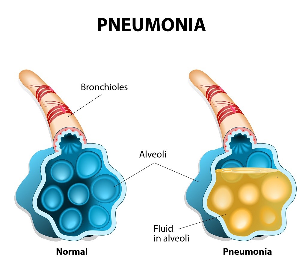 pneumonia vaccine dr vivek baliga