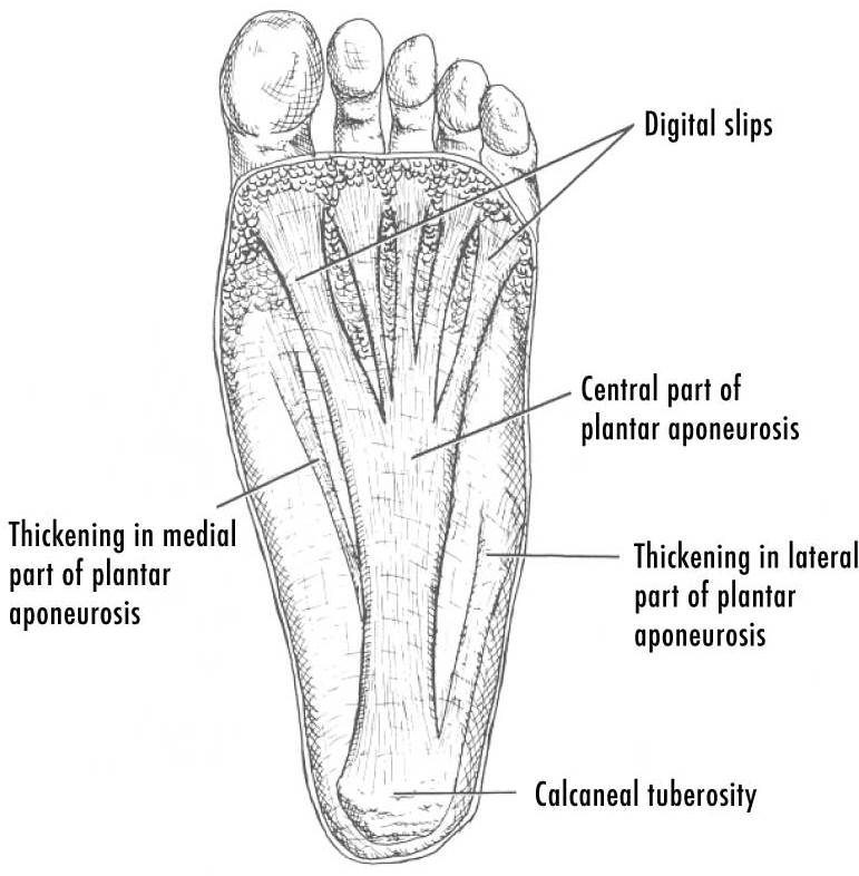 what is plantar fasciitis