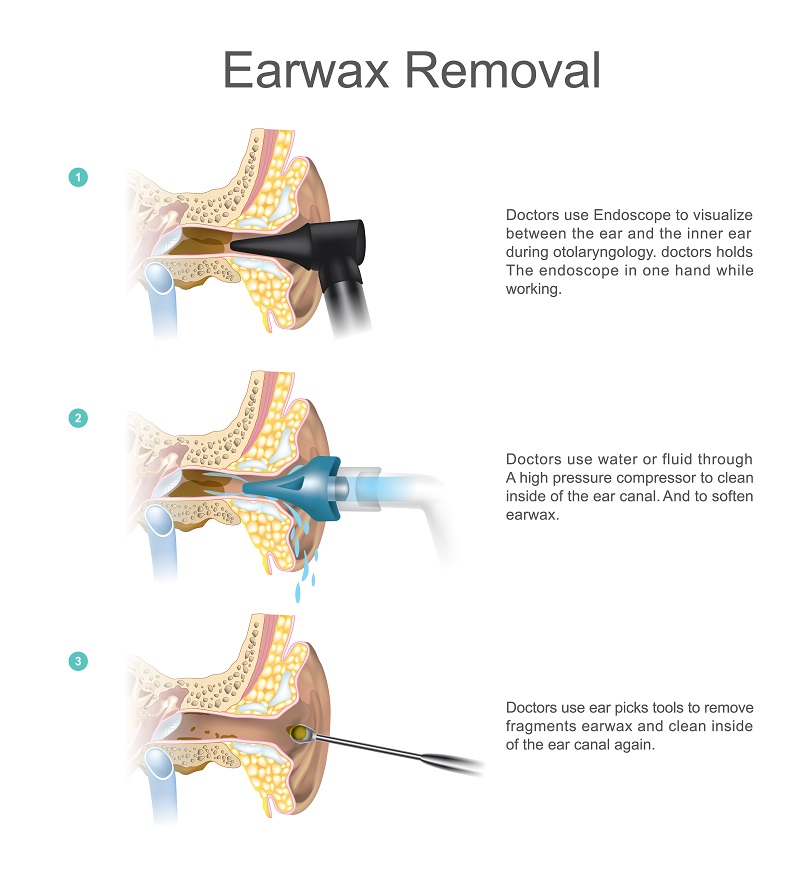 How To Get Dried Earwax Out Of Your Ear at Corey Davey blog