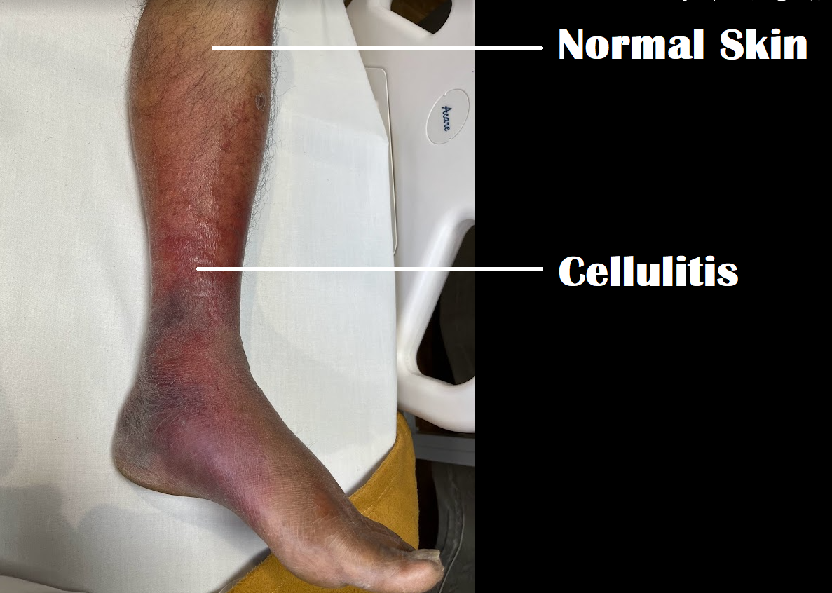 cellulitis-of-the-legs-causes-symptoms-and-treatment